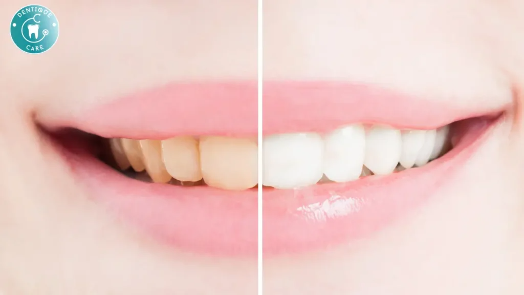 How to Instantly Whiten Teeth at Home: 5 Quick Hacks You Can Try Today