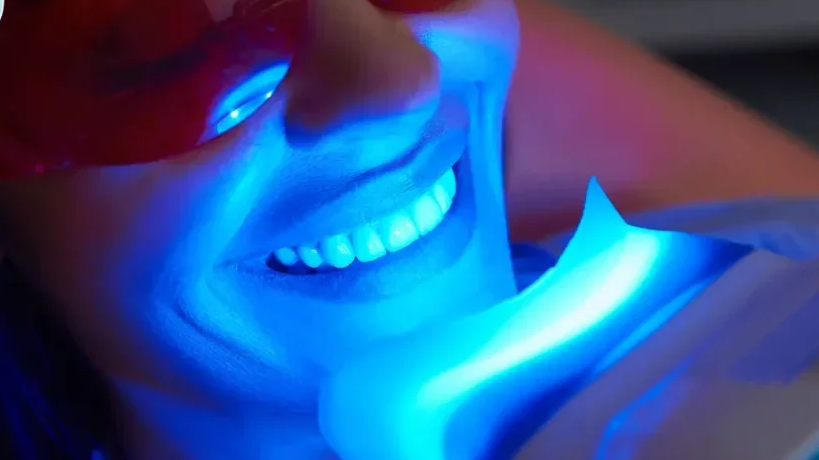Is Teeth Whitening Safe? Myths and Facts Explained