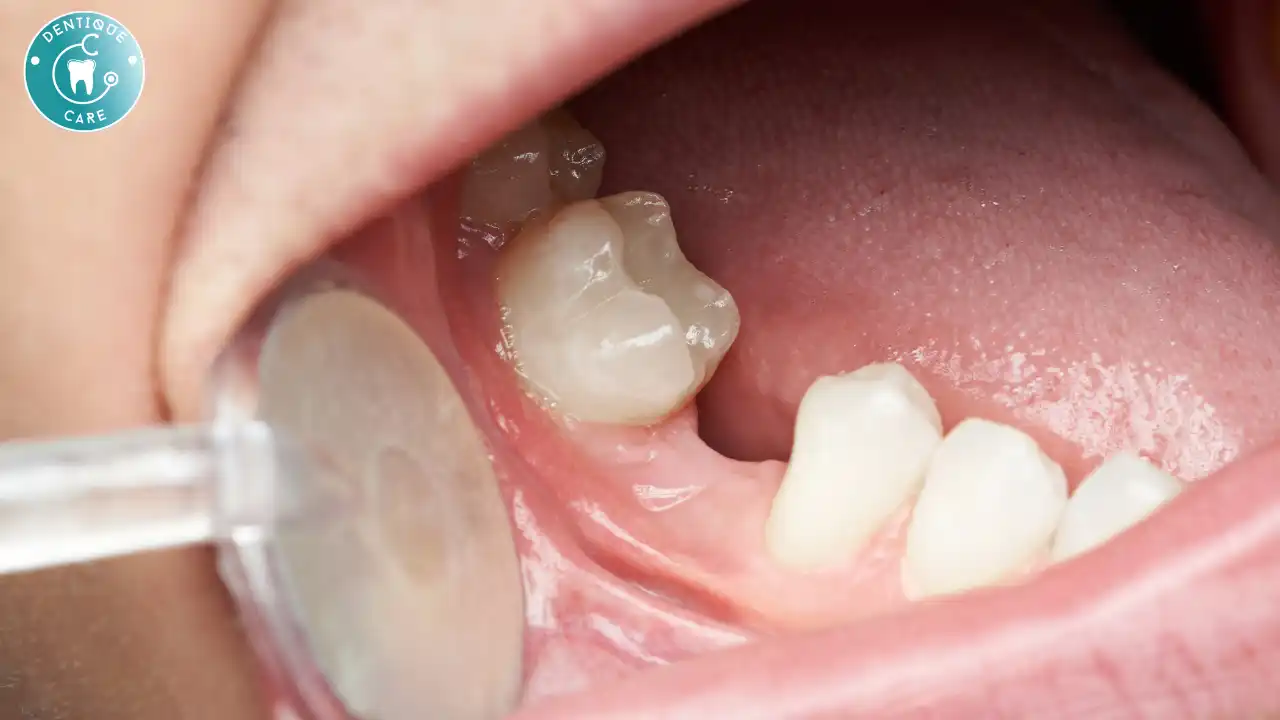 Why Replacing Lost Teeth Is Important: Insights from the Top Dental Clinic in Lucknow